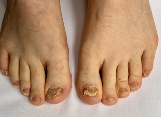 Onychomycosis. Dangerous fungal infection of human toenails on a white background at the doctor....