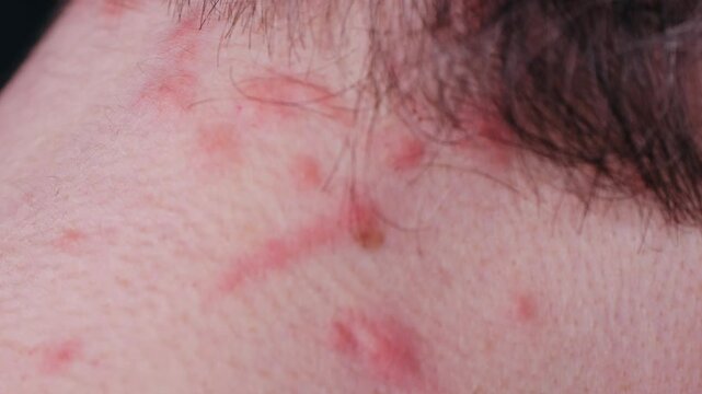 Man scratches neck bitten by a bedbug on a white background, close-up. Skin health problem allergy, Red pimples.