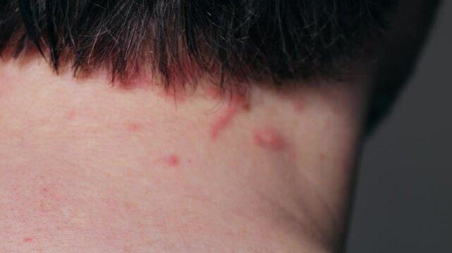 Man scratches neck bitten by a bedbug on a white background, close-up. Skin health problem allergy, Red pimples.