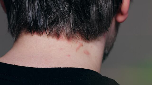 Man scratches neck bitten by a bedbug on a white background, close-up. Skin health problem allergy, Red pimples.