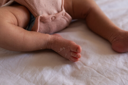 Skin peeling off newborn's feet