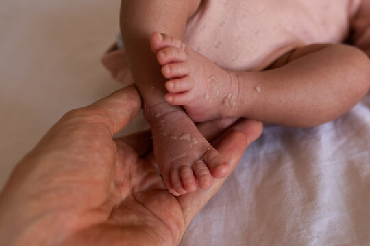 Father checking peeling skin of newborn