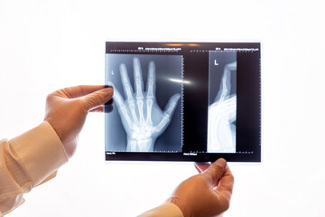 A doctor or radiologist is carefully reviewing a hand x-ray. Image shows two views of a patient's...