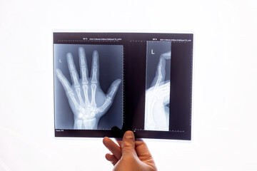Doctors hand holding a digital display presenting two x-ray images of a wrist. Detailed images clearly depict the bones