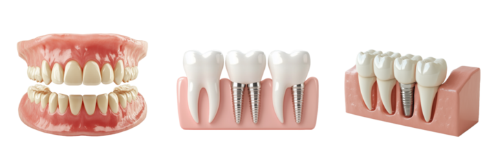 Dental Implants and Dentures Complete Tooth Replacement Options