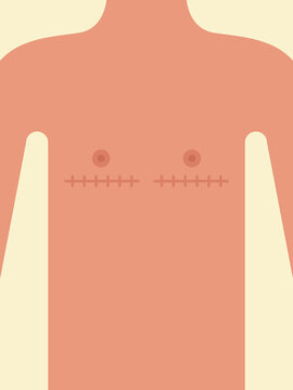 Female body with scars from breast removal