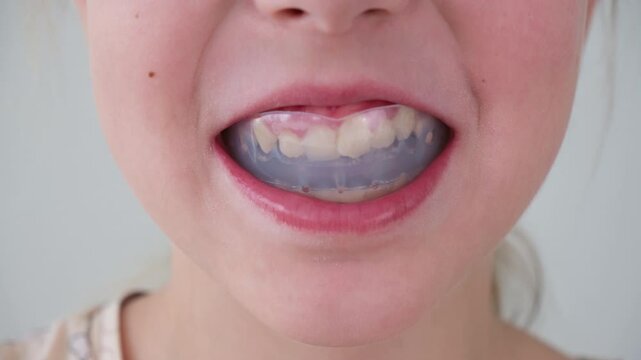 Dental simulator for teeth alignment . The child has mouth guards on his teeth.