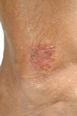 Skin disease winter