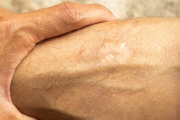 Close-Up of Scar on Human Skin with Fine Hair and Rough Detailed Texture - Realistic Dermatology Concept