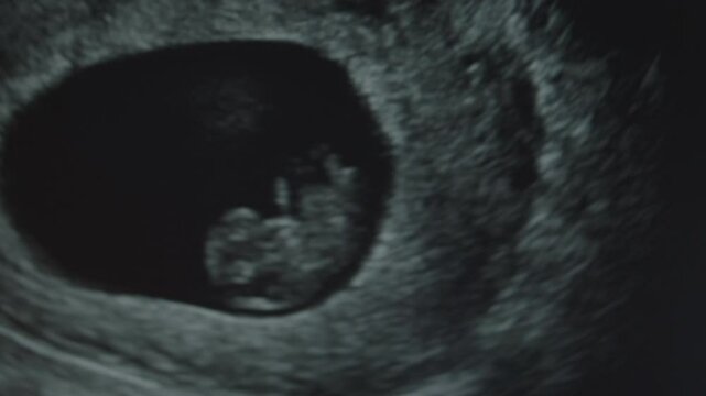 Ultra Sound of a Baby at 9 Weeks