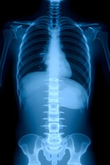 X-ray of a human chest and abdomen, showing the bones, lungs, heart, and some abdominal organs