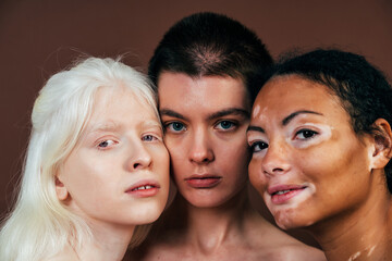 Group of multiethnic women with different kind of skin posing together in studio. Concept about...