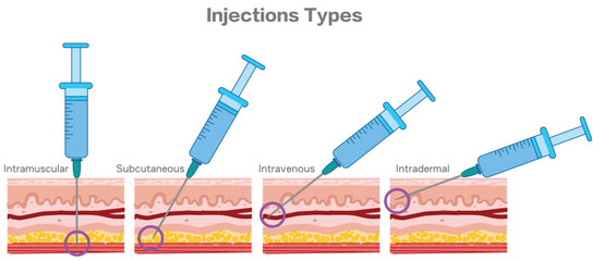 Injection angle types. Intramuscular, subcutaneous intradermal, intravenous injection. Guide injecting medication into skin, holding syringes. Vector illustration