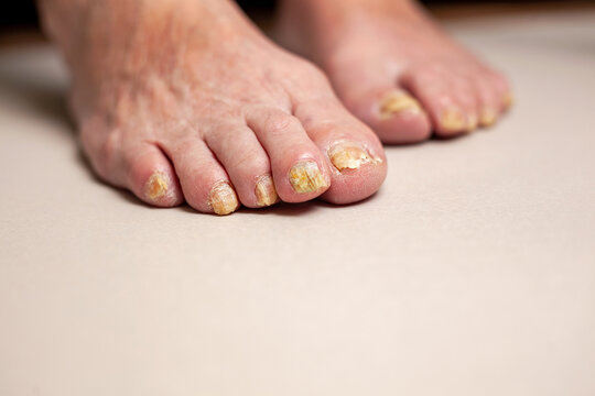 Onycholysis of nails, Paramedicine, medical pedicure, aging problems. Toenails affected by fungal infection isolated on a white background. Toenail fungus from