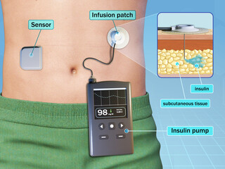 Insulin pump with wireless sensor