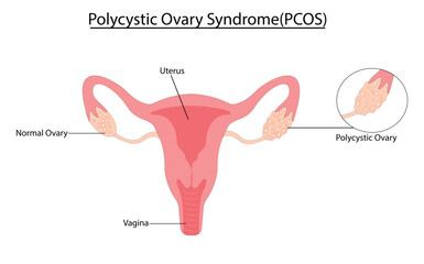 Obraz premium Polycystic Ovary Syndrome (PCOS) vector illustration