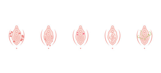 女性外性器の病気