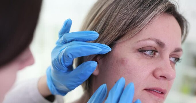 Dermatologist examines irritated birthmark on woman face at clinic appointment. Doctor studies pigmentation on middle aged lady facial skin in office