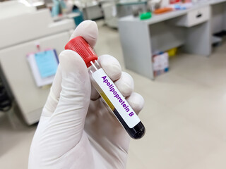 Scientist hold blood sample for Apolipoprotein-B test. Healthcare and medical test concept.