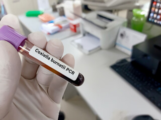 Scientist hold blood sample for Coxiella burnetii PCR test. Healthcare and medical test concept.