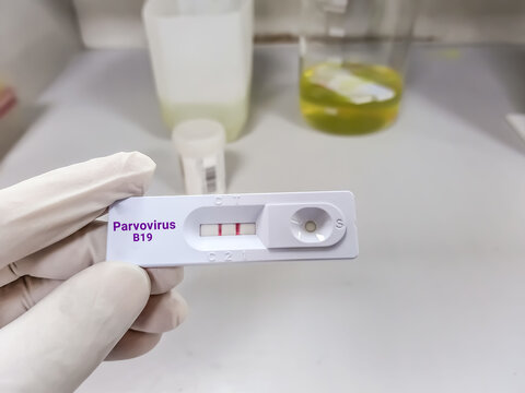 Scientist hold  rapid cassette for Parvovirus B19 test. Healthcare and medical test concept.