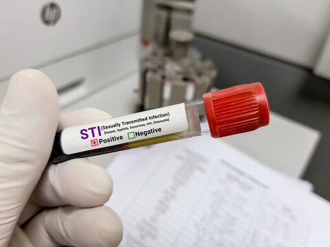 Doctor hold Blood sample for STI (Sexually Transmitted Infection) Test. Positive result test tube.