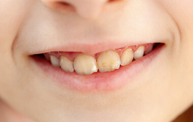 Close up of a child's smile revealing teeth affected by hypomineralization, a developmental defect...