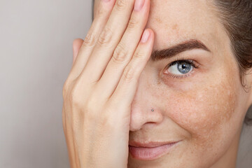 Woman's face with freckles or age spots. Age spots on the face, melasma. Beautiful blue eye close...