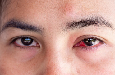 Close up of a severe bloodshot of mature adult women affected by conjunctivitis or Conjunctivitis...
