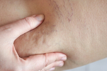 Fototapeta premium Close up of cellulite and stretch marks on caucasian female skin with hand touching affected area.