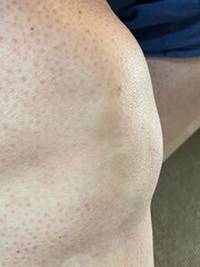 Swollen knee of leg with bursitis 