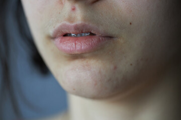 Close-up of a woman's lips and lower face with natural skin texture, blemishes, and soft lighting