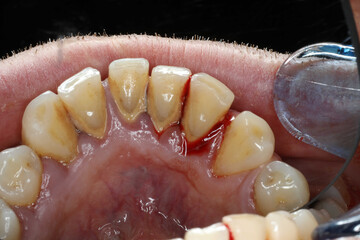 Inflamed bleeding gums, sore gums, gum infection, mouth concept, health.