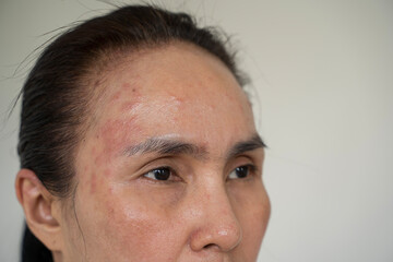 Asian woman with acne problem occur on her face. Cropped shot of young woman's face with acne...