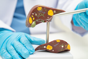 Cirrhosis, Liver cancer, fatty liver, Asian doctor with liver human anatomy model in World...