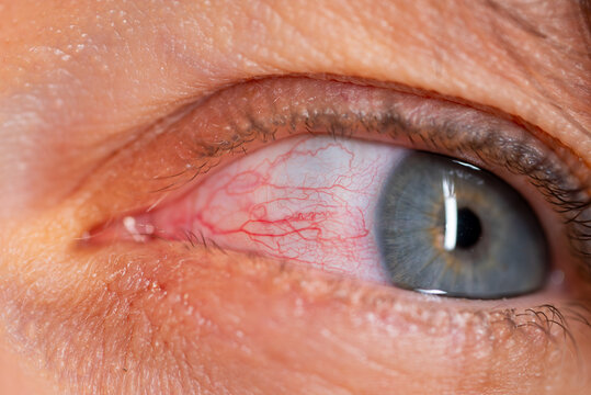 Red irritated eye showing prominent capillaries and signs of infection or inflammation, highlighting eye health issues and potential medical conditions