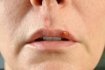 Close-up of a common cold sore virus herpes simplex   