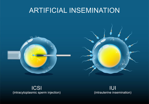 Artificial insemination. Sperm donation. Fertility treatment.