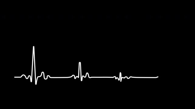 Heart failure, cardiac arrest, wave attenuation chart self drawing animation. Animated white line on black background.