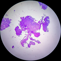 Helicobacter Pylori Infection With Chronic Active Gastritis