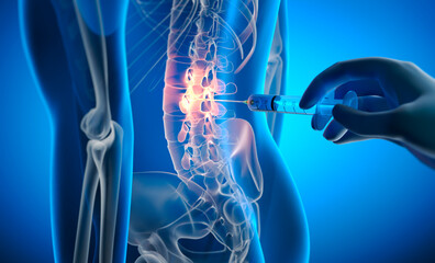 X ray 3D illustration with blue background of spinal drug injection for lower back pain treatment 