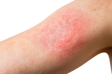 Fototapeta premium Varicose veins on the skin of a young woman, close-up. isolated on transparent background, cut out. 