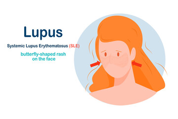 Flat illustration of Lupus disease. Butterfly rash on woman face. Medical illustration concept.