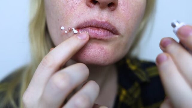 Herpes on the lips of women. A dermatologist examines and treats with ointment fever blisters of the herpes simplex virus