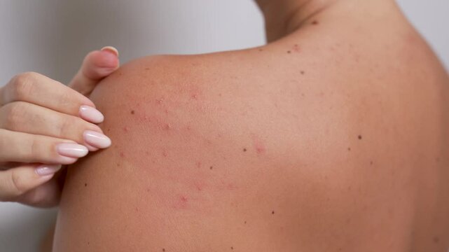Close-up of a young woman scratching red acne bumps on her shoulder with nails. Skin irritation, heat rash or sun allergy captured in a raw and relatable moment of discomfort and real body experience
