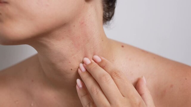 Red rash under jaw. Young woman touching her neck with hands showing acne problem. Allergies, pimples, hormonal changes. Problem skin, sweating sickness, prickly heat. Dermatology. Close-up