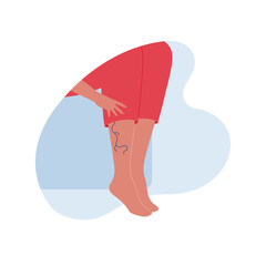Varicose disease for healthcare concept collection. Vector flat character illustration. Vascular disease diagnostic and treatment. Female legs with spider vein. Design for health care, education