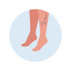 Varicose disease for healthcare concept collection. Vector flat character illustration. Vascular disease diagnostic and treatment. Human leg with weak vein. Design for health care, education