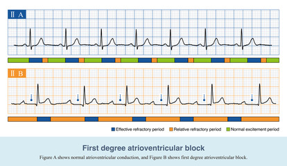 In the first degree of atrioventricular block, the PR interval was prolonged by more than ＞200ms, and there was no QRS wave loss in ECG. The blocking site can occur anywhere in the conduction system.
