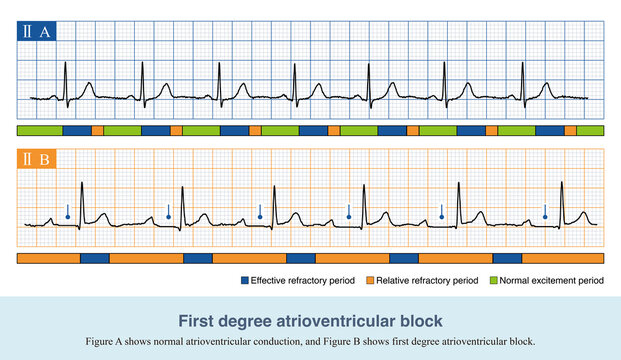 In the first degree of atrioventricular block, the PR interval was prolonged by more than ＞200ms, and there was no QRS wave loss in ECG. The blocking site can occur anywhere in the conduction system.
